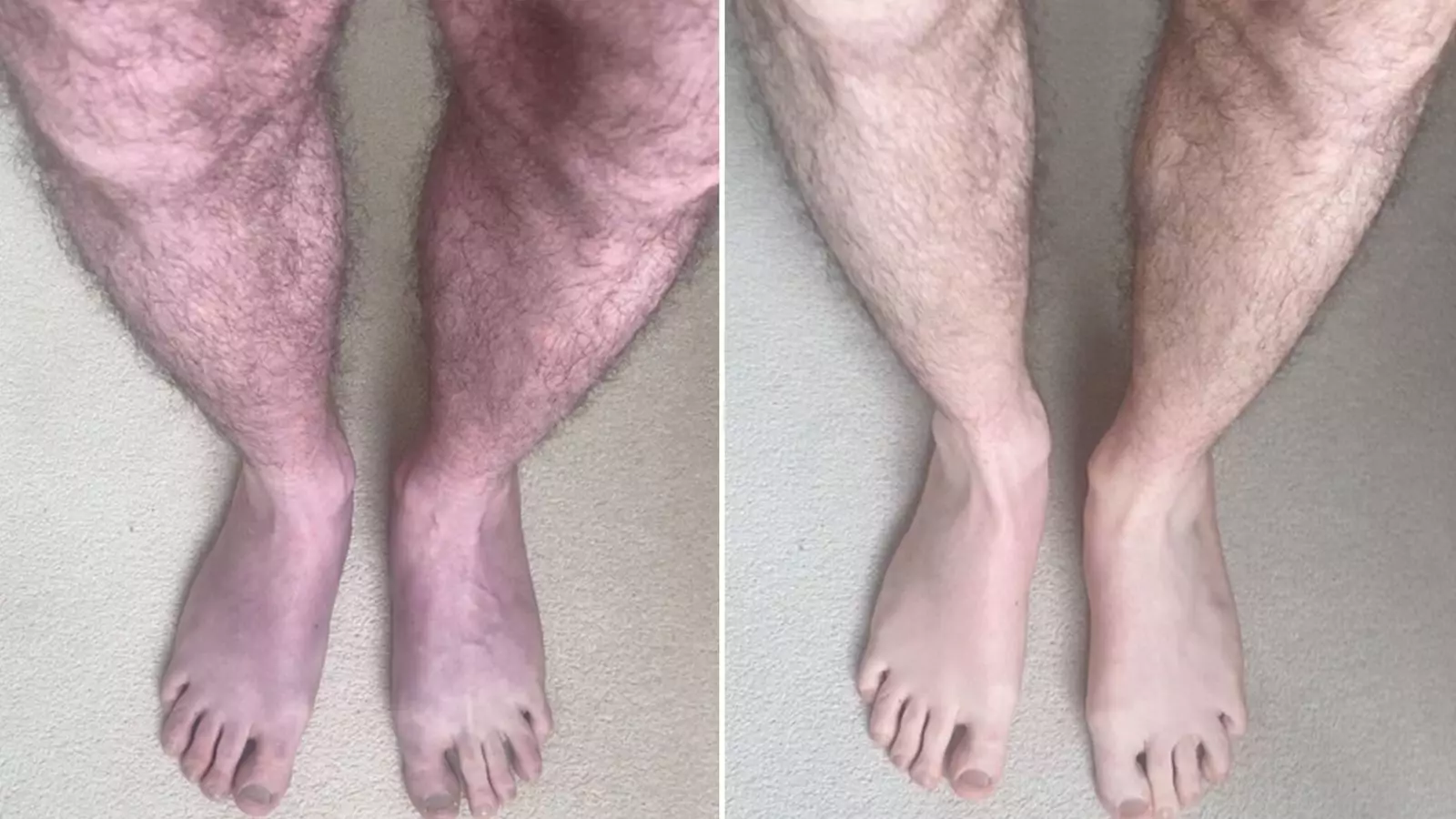 An Unusual Case of Long COVID: Legs Turning Blue After Standing