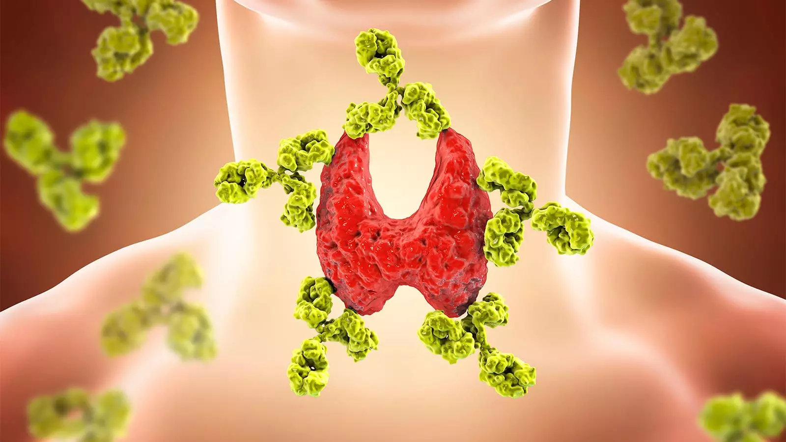 The Long-Term Effects of Total Thyroidectomy on General Health in Patients with Euthyroid Hashimoto’s Thyroiditis