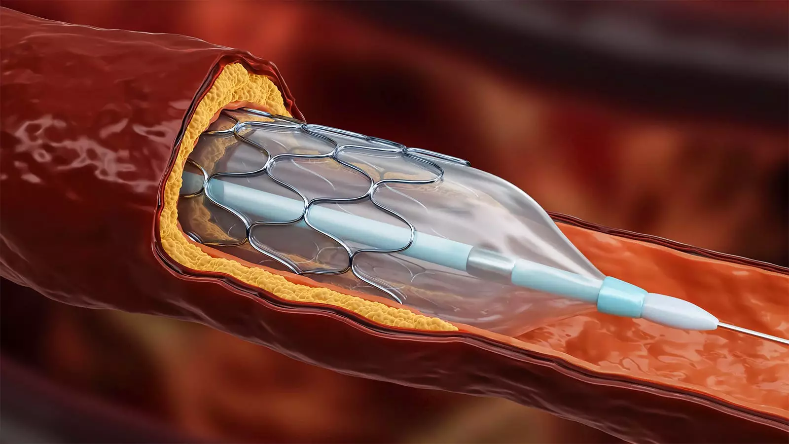 The Cost-Effectiveness of Fractional Flow Reserve (FFR) Guidance in Acute Myocardial Infarction