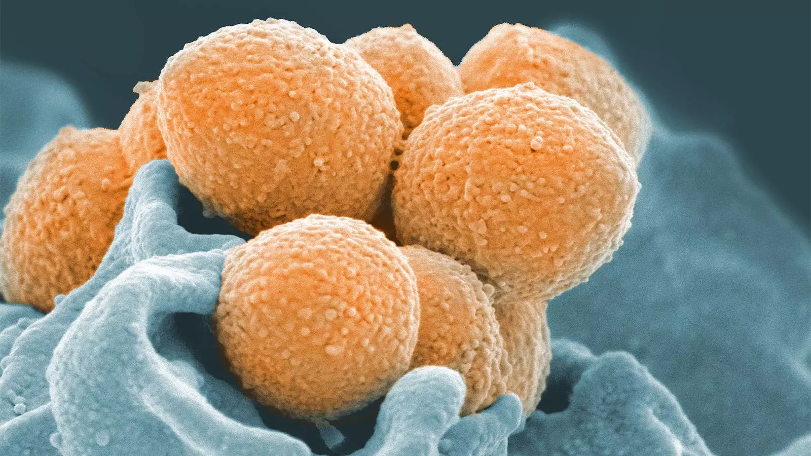 The Rising Threat of Invasive Group A Streptococcus Infections