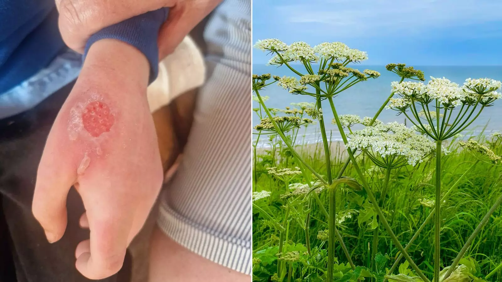 Child suffers burns after coming into contact with harmful plant