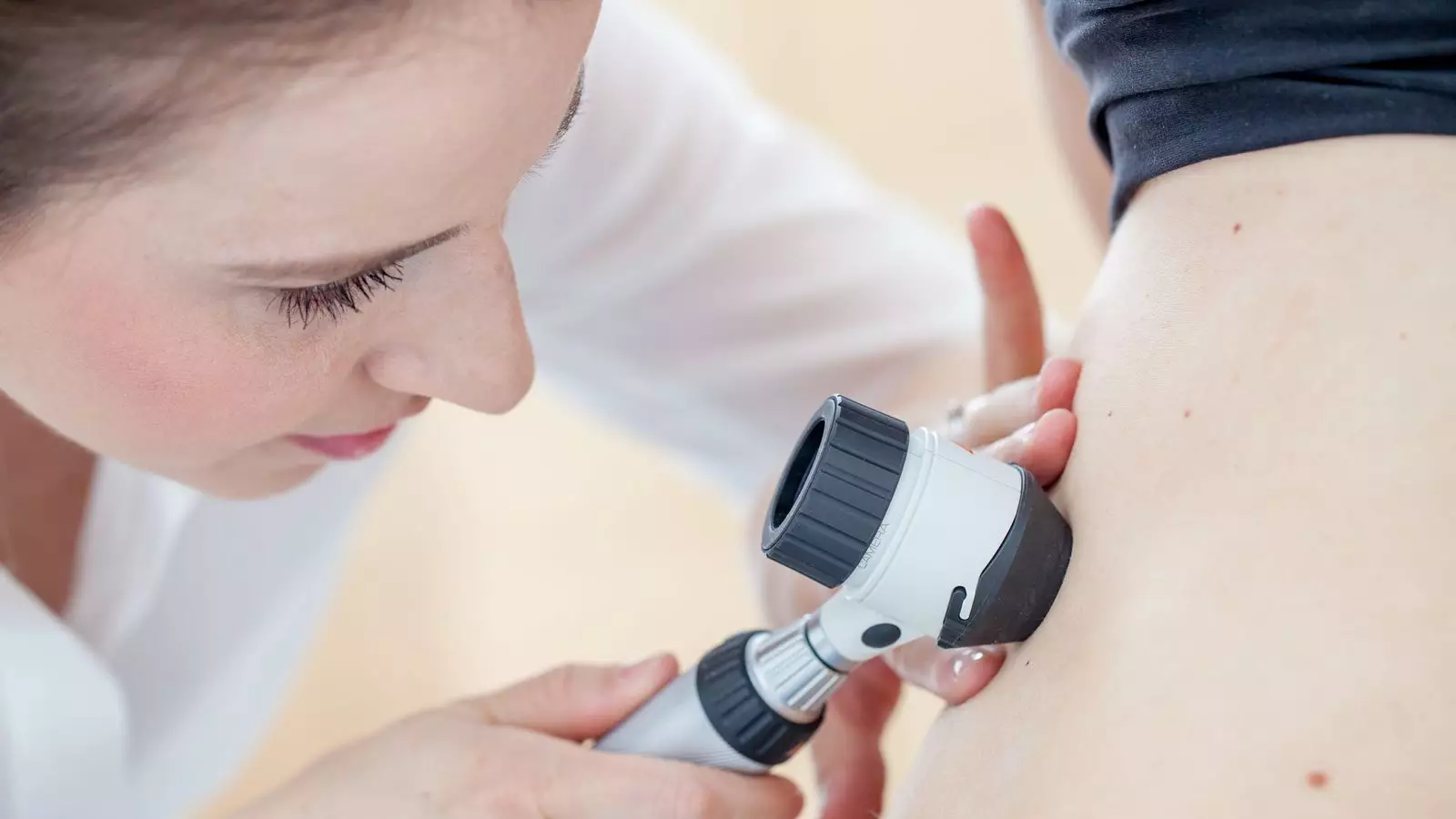 Melanoma Skin Cancer Cases on the Rise in the UK