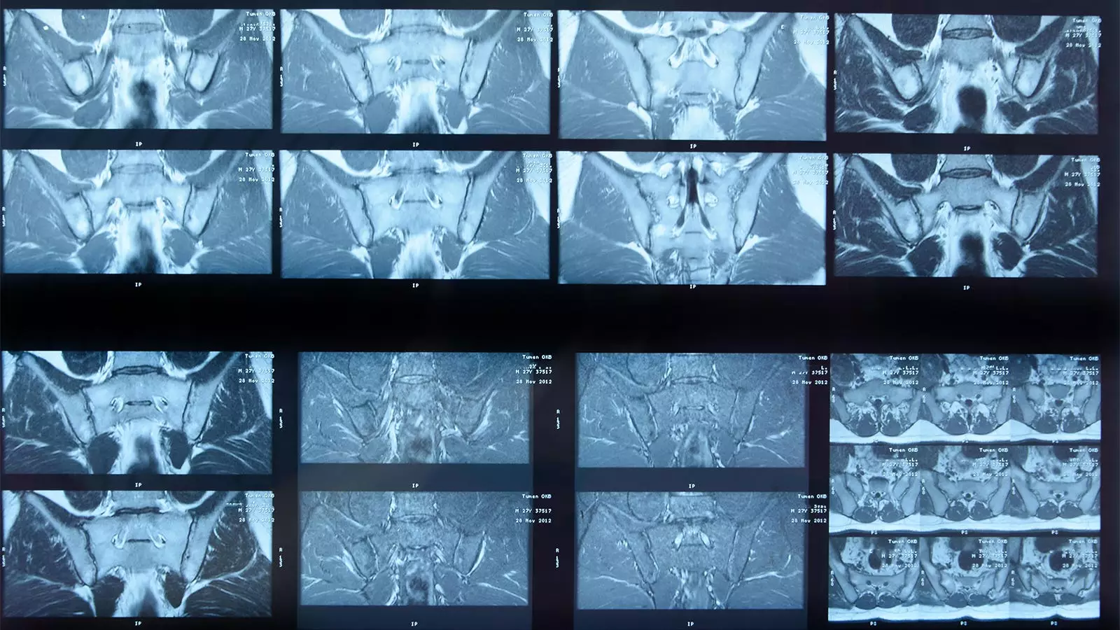 Evaluating the Efficacy of AI in MRI Scan Analysis for Axial Spondyloarthritis