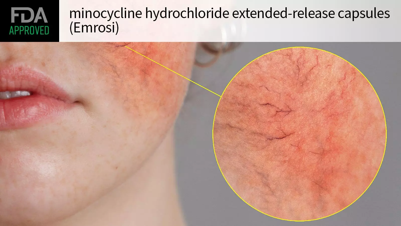 The Approval of Minocycline Hydrochloride: A New Era for Rosacea Treatment