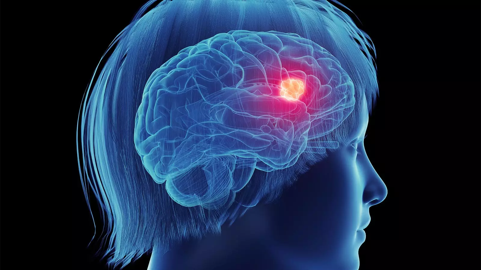 Understanding the Complex Relationship Between Hormone Therapy and Glioma Risk in Women